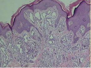 血管瘤好可怕,孕妈妈该怎么预防?