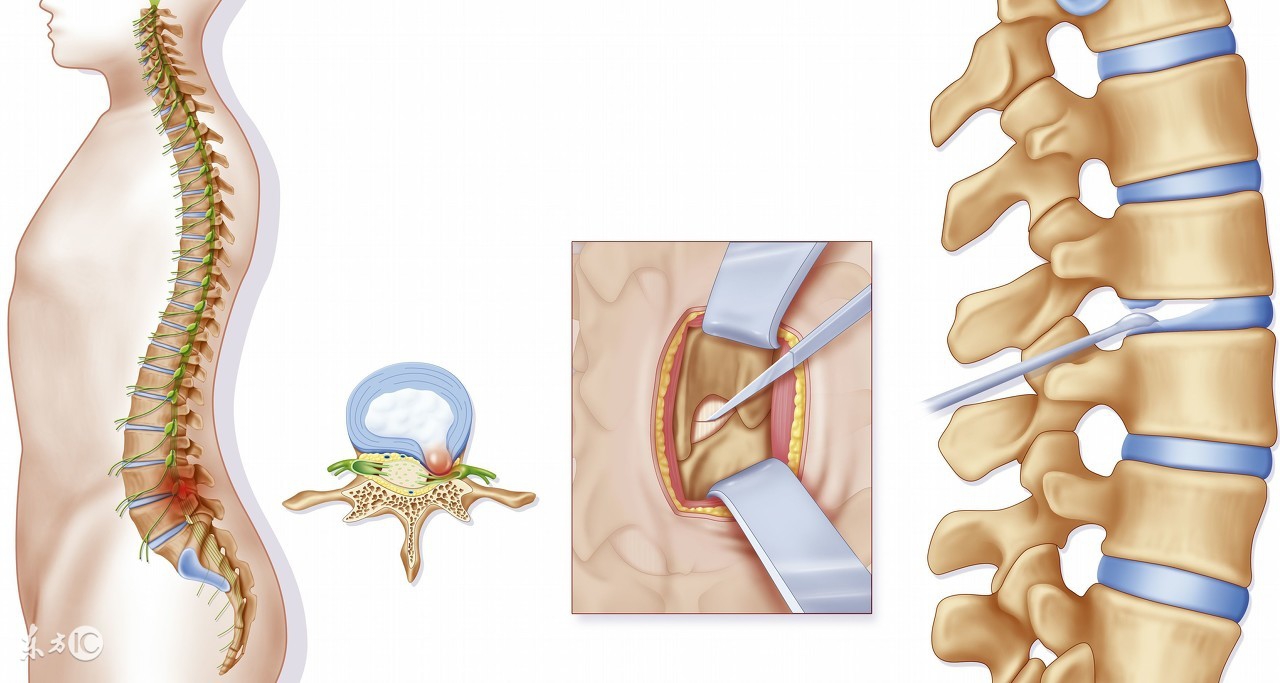 走路锻炼可以缓解腰椎间盘突出吗,腰椎间盘突出吊单杠正确锻炼方法