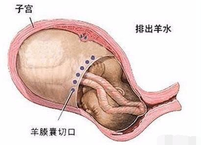 剖腹产手术全过程图解，需要切开7层才能将宝宝取出