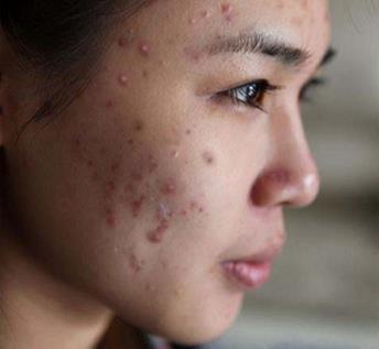 油腻痘痘肌肤怎么快速改善,油性肌肤如何预防痘痘