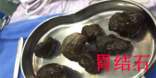 鞣酸与什么形成结石,鞣酸和胃酸反应吗