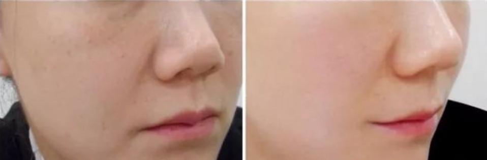 prp自体血清修复疗法,prp自体血清注射面部恢复期