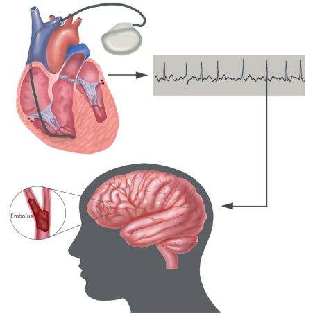 年轻人什么原因引起的房颤,年轻人房颤的原因