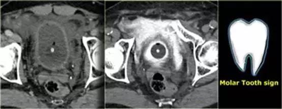 腹腔脏器炎症ct可以查出来吗,腹腔脏器ct表现图像