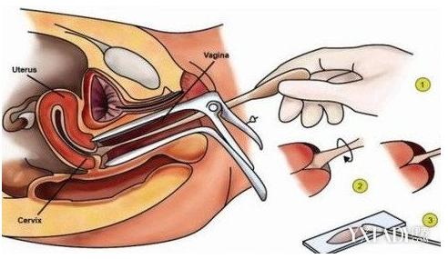 宫颈癌的检查有哪些方法,宫颈癌hpv检查多少钱