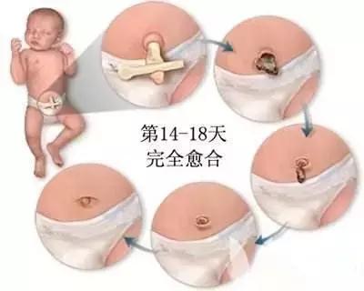 月嫂课堂练习新生儿脐带消毒,宝宝脐带护理月嫂处理