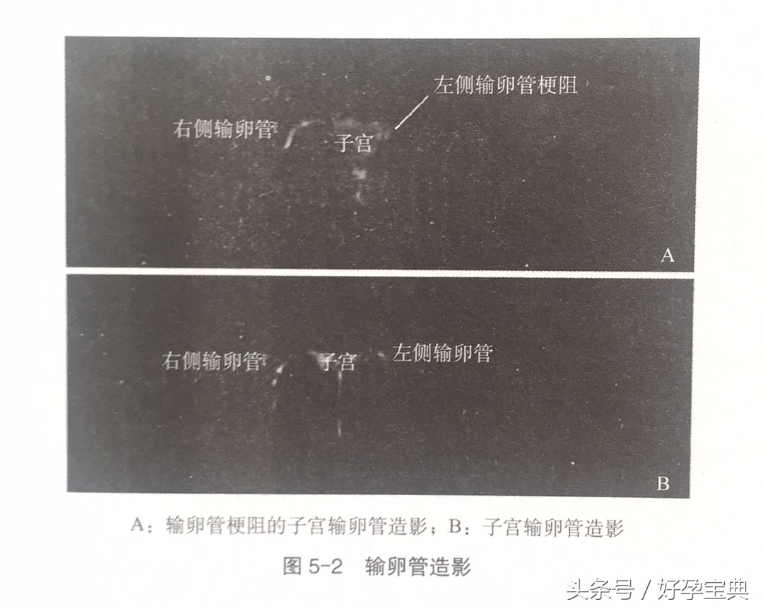 输卵管堵塞影响试管婴儿成功率吗,女性输卵管堵塞能不能做试管婴儿