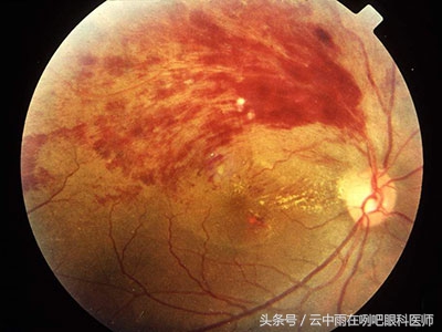 眼底出血手术大概多少钱,眼底出血吃什么菜好得快