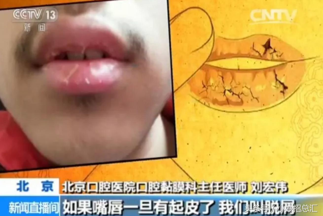 秋冬唇怎么护理,换季唇的正确护理方法