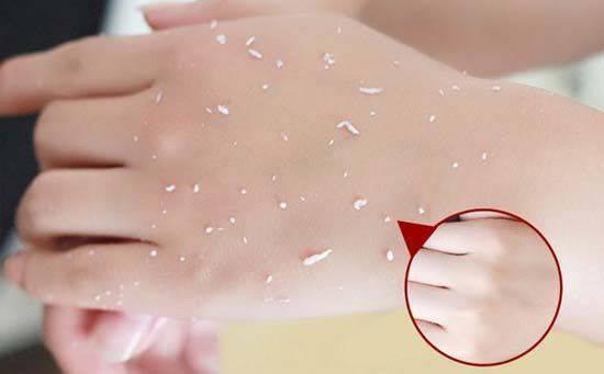 痘痘爆发的10大影响因素,痘痘一直不好因为做错了这几件事