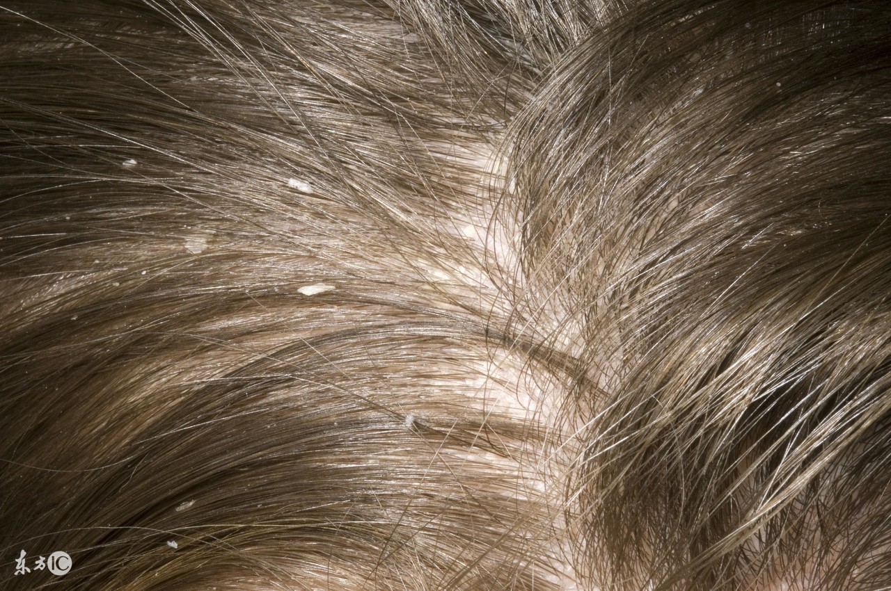 头皮屑突然增多是癌症的前兆吗,大块头皮屑可能是得了癌症吗