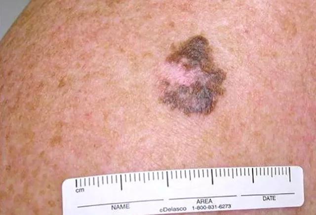 5招教你辨别痣和瘤,怎样区分痣和瘤