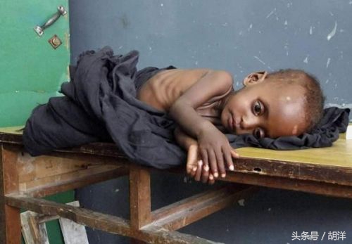 肺结核让人元气大伤,肺结核病人最后痛苦吗