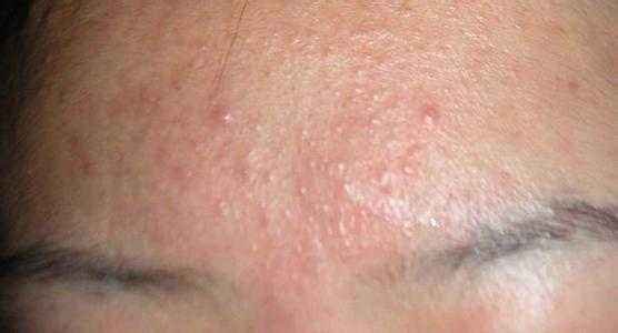 额头长痘是什么原因以及解决办法,额头长痘忌讳什么