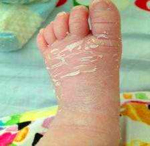 妈妈们不必惊慌新生儿的常见症状,1-30天新生儿常见问题