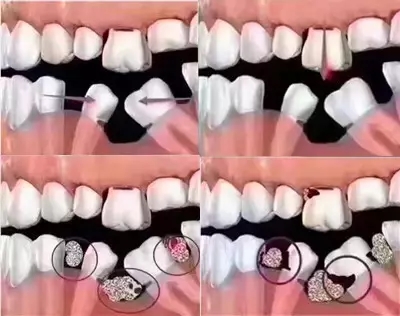 只需四步轻松治疗牙周病，再也不用受牙龈出血、疼痛之苦！