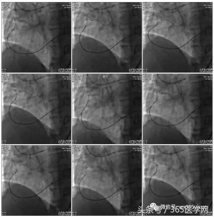 冠脉介入术的介绍,复杂冠脉介入病例