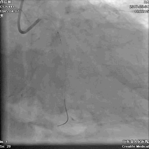 冠脉介入术的介绍,复杂冠脉介入病例