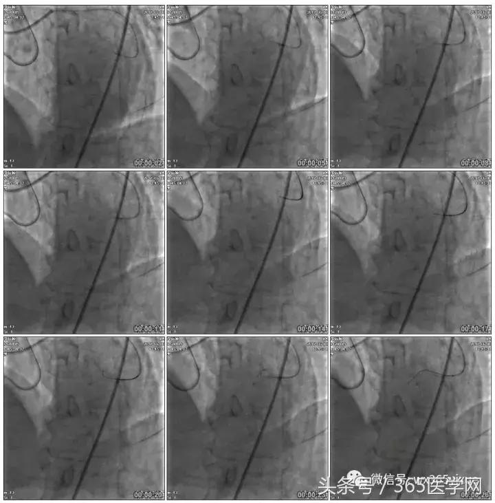 冠脉介入术的介绍,复杂冠脉介入病例