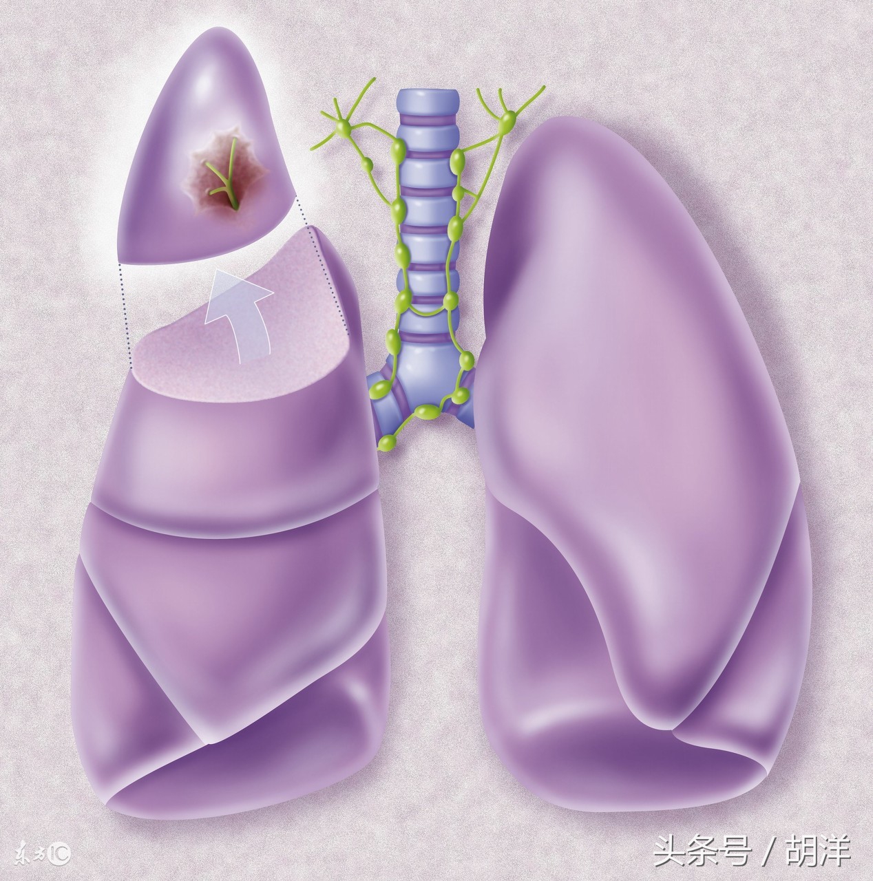 肺部肉芽肿和肿瘤几率各一半,肺上长脓包是个严重的病吗
