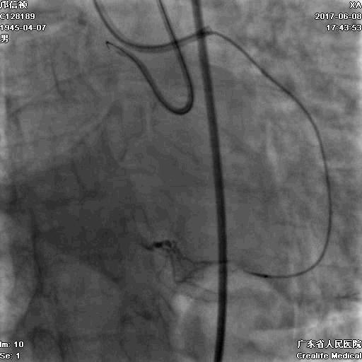 冠脉介入术的介绍,复杂冠脉介入病例