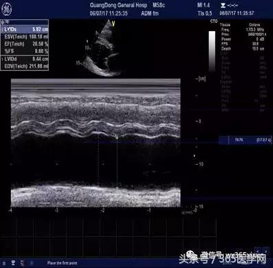 冠脉介入术的介绍,复杂冠脉介入病例