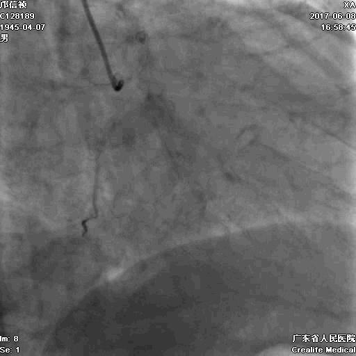冠脉介入术的介绍,复杂冠脉介入病例