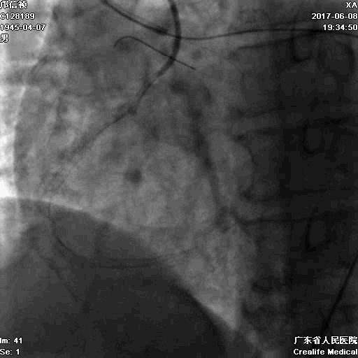 冠脉介入术的介绍,复杂冠脉介入病例