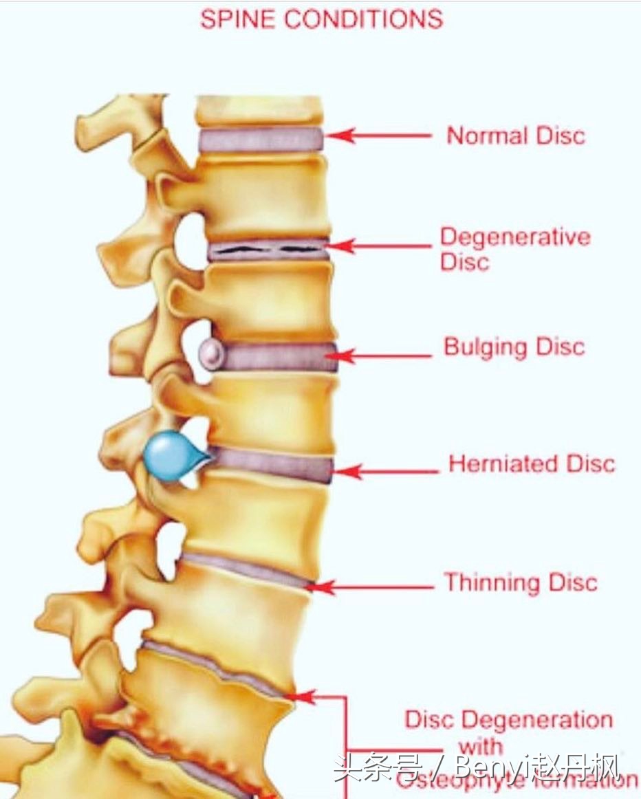 减缓腰椎疼痛的药,减缓腰椎间盘突出疼痛的按摩手法