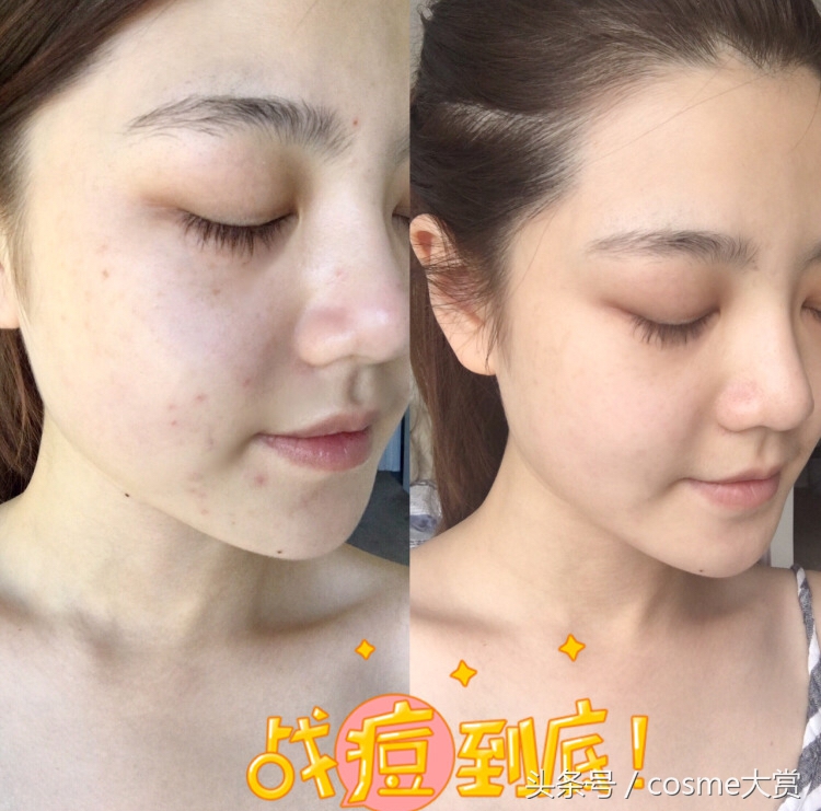 混干皮敏感痘痘肌怎么护肤,混油敏感痘痘肌怎么调理