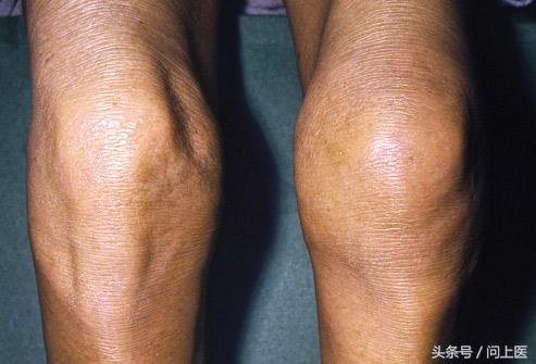 膝盖疼痛的原因和解决方法,膝盖上下楼疼痛的原因和解决方法