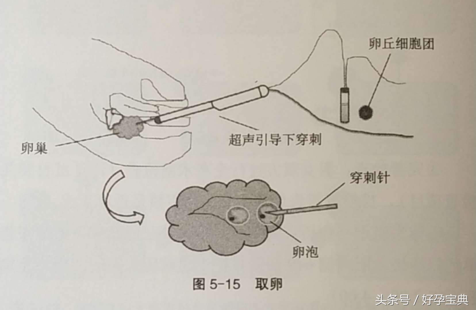 试管婴儿流程及治疗费用,什么叫试管婴儿怎么做
