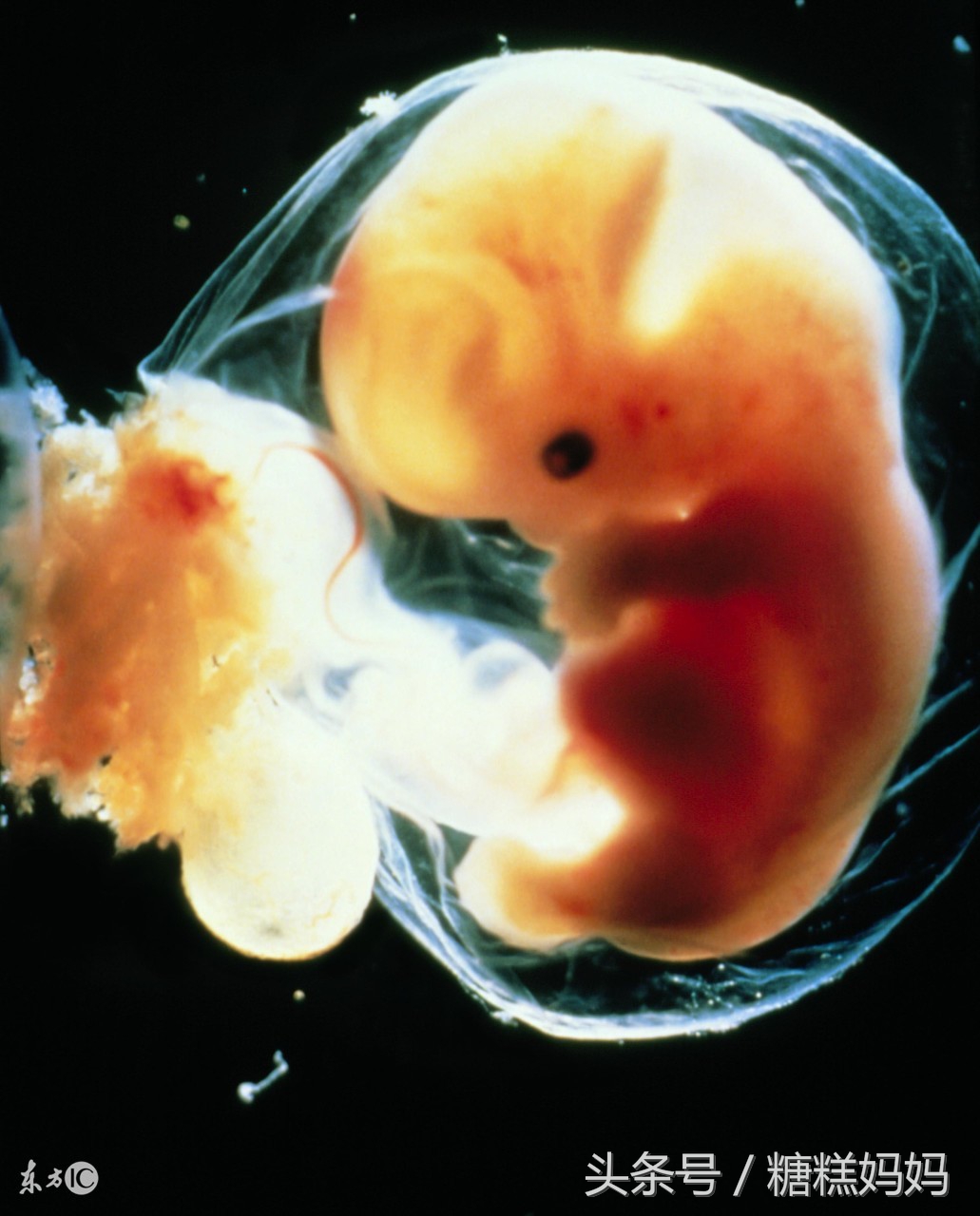 孕期须知:羊水破了是什么症状,有哪些注意事项