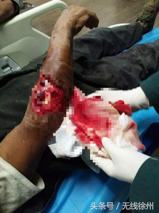 深秋警惕萌宠变“猛”宠,徐州仁慈昨夜连续收治2位被狗咬伤患者