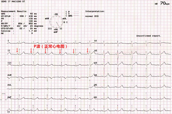 心脏房颤中医能治疗吗,老年心脏房颤吃什么药