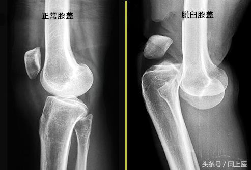 膝盖疼痛的原因和解决方法,膝盖上下楼疼痛的原因和解决方法