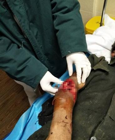 “秋燥”狗狗情绪多变徐州一医院收治两名被狗咬伤患者