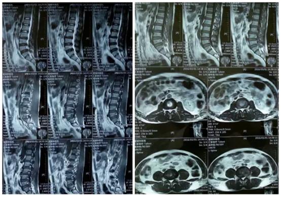 椎间盘突出症椎间孔镜术的概述,椎间孔镜治疗颈椎间盘突出过程