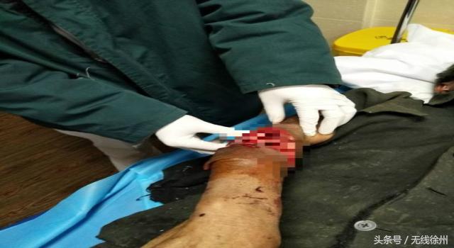 深秋警惕萌宠变“猛”宠,徐州仁慈昨夜连续收治2位被狗咬伤患者