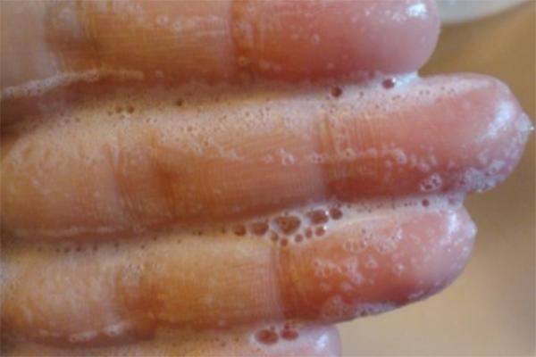 去t字区暗黄的方法,改善t区