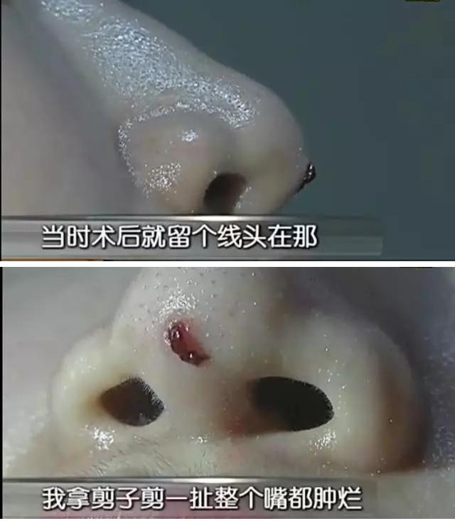 线雕的十大骗局,揭秘线雕埋线你不知道的内幕