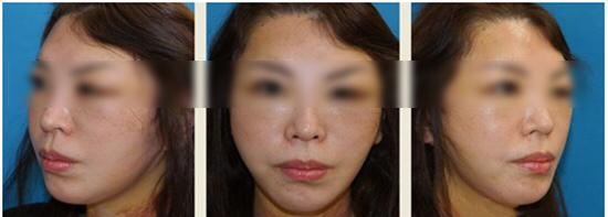 线雕的十大骗局,揭秘线雕埋线你不知道的内幕