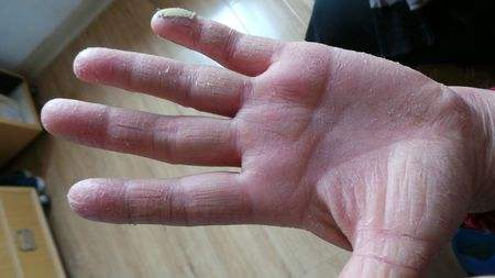 手脚皮肤干燥开裂是缺什么维生素,一到冬天手脚开裂有什么办法治好