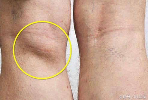 膝盖疼痛的原因和解决方法,膝盖上下楼疼痛的原因和解决方法