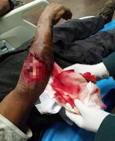 “秋燥”狗狗情绪多变徐州一医院收治两名被狗咬伤患者