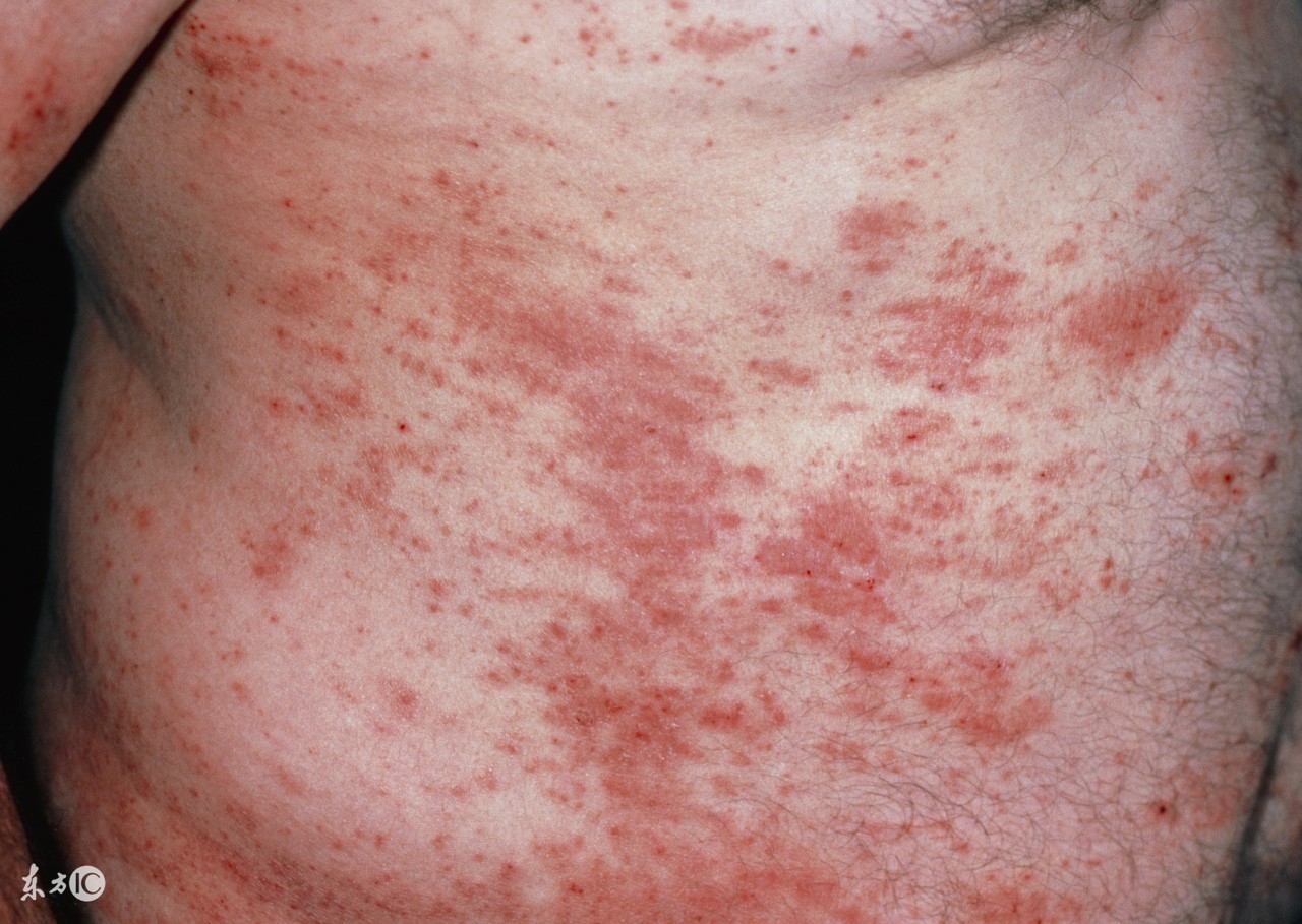 宝宝身上长湿疹可以用什么泡澡,宝宝湿疹饮食注意事项和禁忌