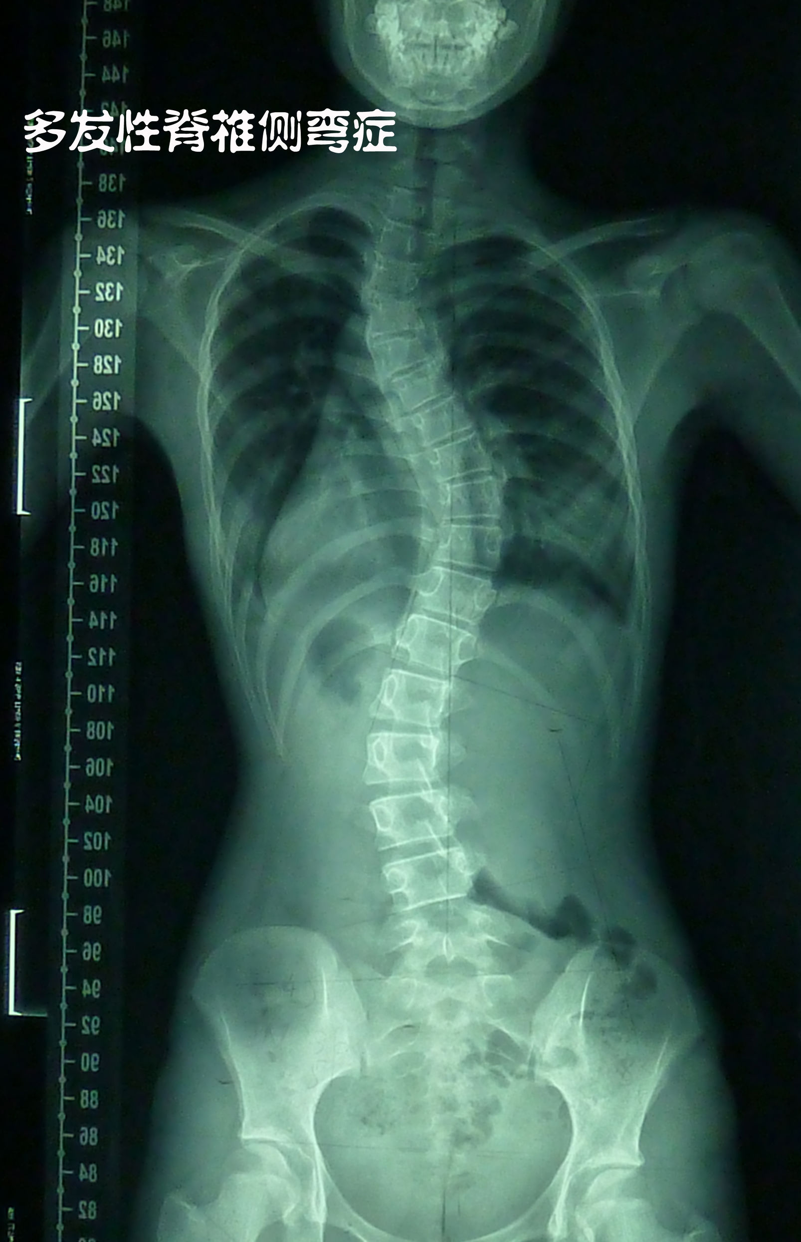 正常范围内的脊柱侧弯图片,脊柱侧弯的凸侧和凹侧