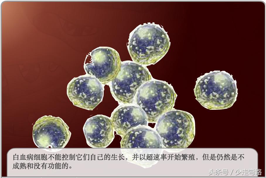 急性淋巴细胞白血病定义,小儿急性淋巴细胞性白血病