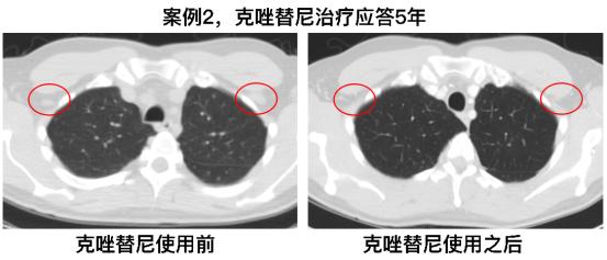 alk靶向药耐药后进行化疗效果好吗,抗肿瘤靶向药物alk
