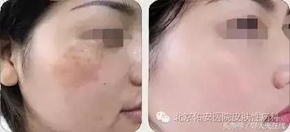 褐斑的最佳治疗方法,褐青色斑最好的治疗方法